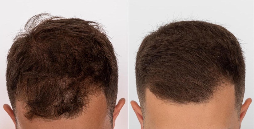 Kirkland Minoxidil 5% Extra Strength