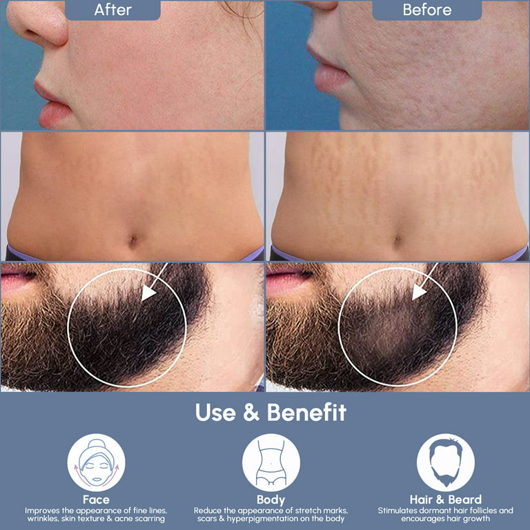 Derma Stamp - Adjustable 0-3mm