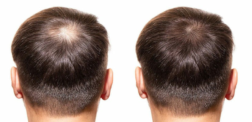 Kirkland Minoxidil 5% Extra Strength